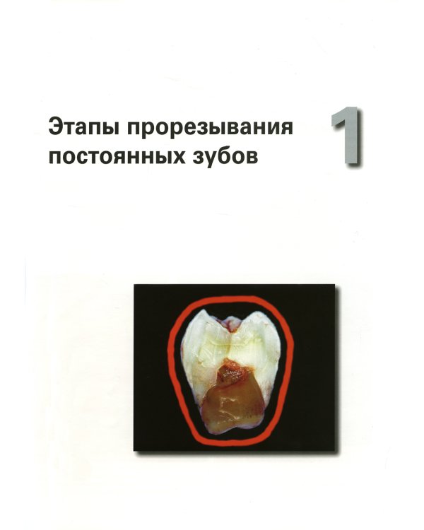 Хирургическое и ортодонтическое лечение ретинированных зубов