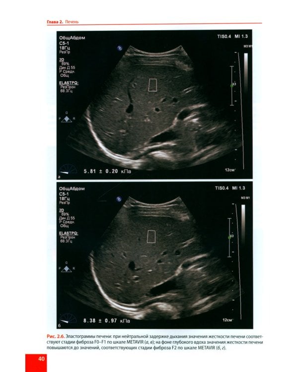 Ультразвуковая эластография. От простого к сложному
