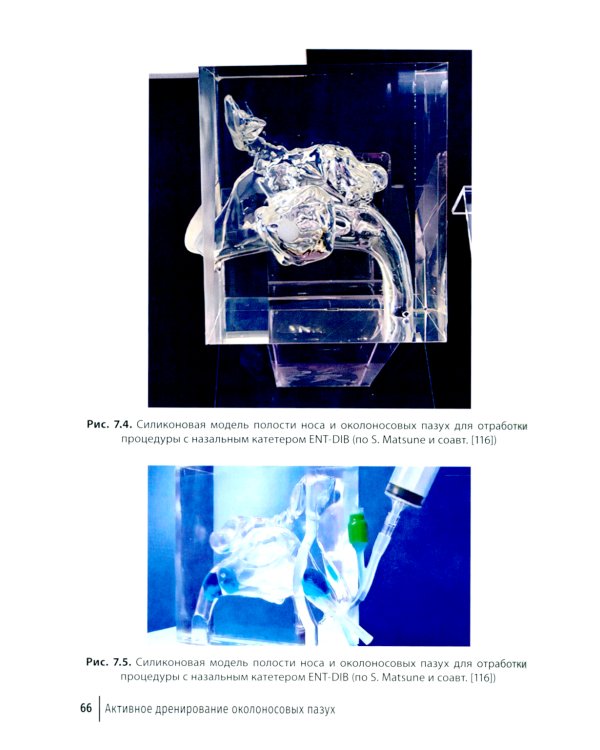 Активное дренирование околоносовых пазух при остром риносинусите