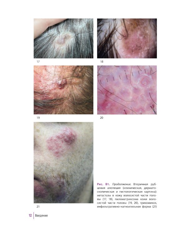 Первичные рубцовые алопеции: диагностика и лечение: иллюстрированное руководство для врачей