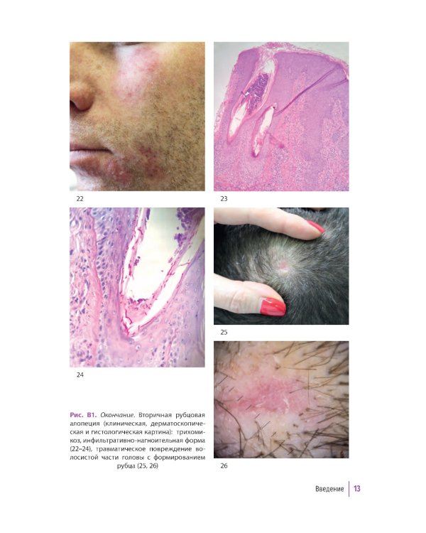 Первичные рубцовые алопеции: диагностика и лечение: иллюстрированное руководство для врачей