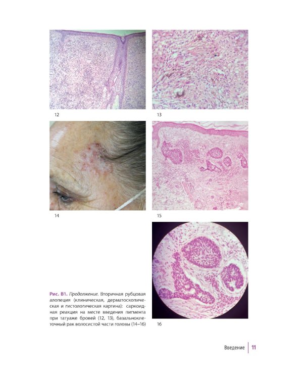 Первичные рубцовые алопеции: диагностика и лечение: иллюстрированное руководство для врачей