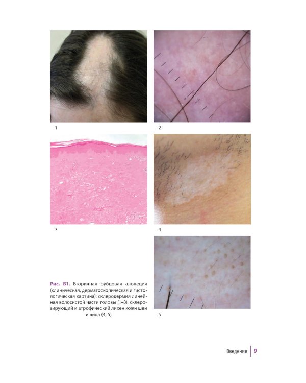 Первичные рубцовые алопеции: диагностика и лечение: иллюстрированное руководство для врачей