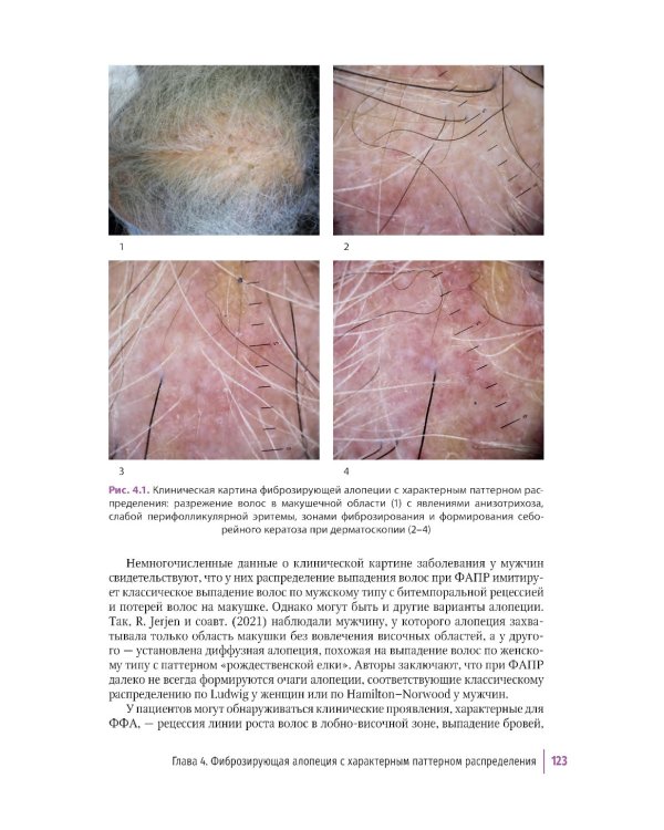 Первичные рубцовые алопеции: диагностика и лечение: иллюстрированное руководство для врачей