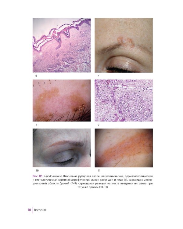 Первичные рубцовые алопеции: диагностика и лечение: иллюстрированное руководство для врачей