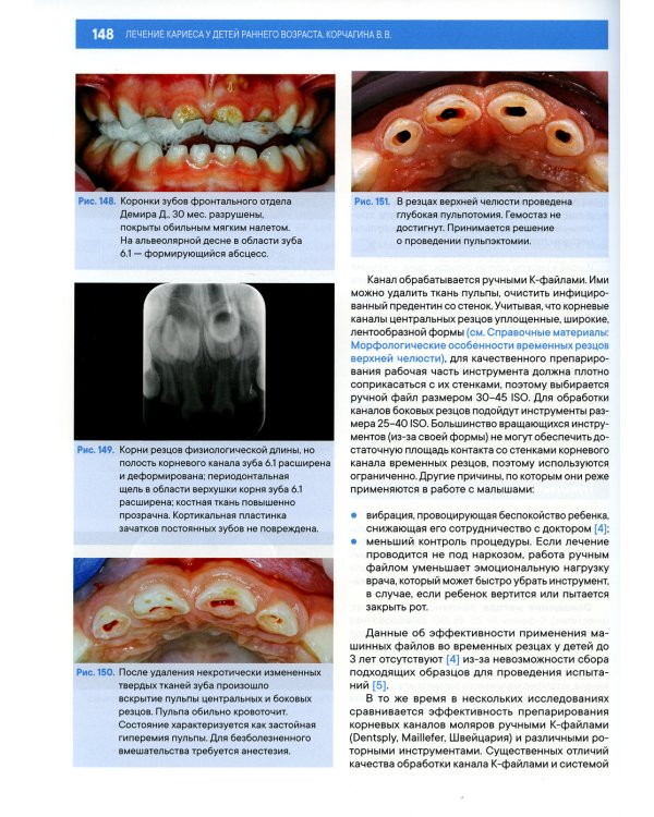 Лечение кариеса у детей раннего возраста