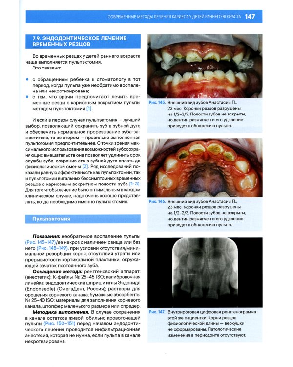 Лечение кариеса у детей раннего возраста