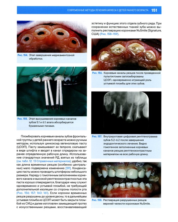 Лечение кариеса у детей раннего возраста