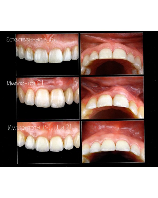 Эволюция. Актуальные протоколы замещения передних зубов с помощью имплантатов