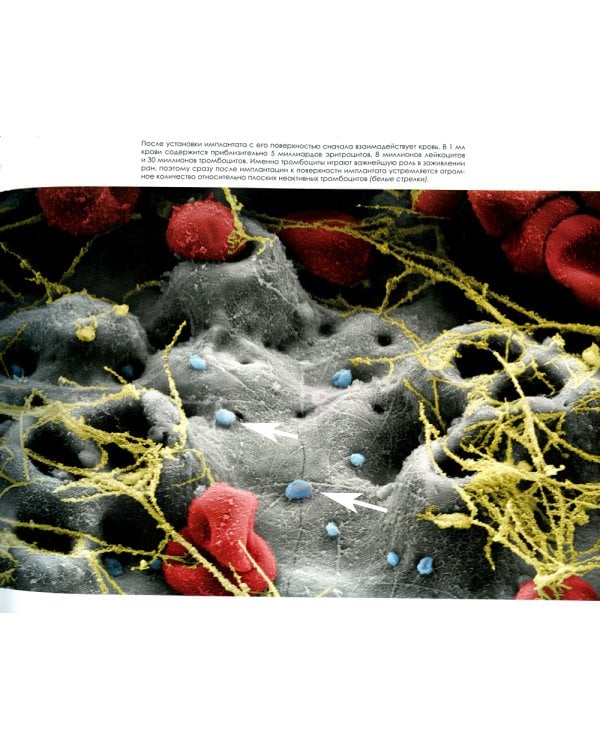 Эволюция. Актуальные протоколы замещения передних зубов с помощью имплантатов