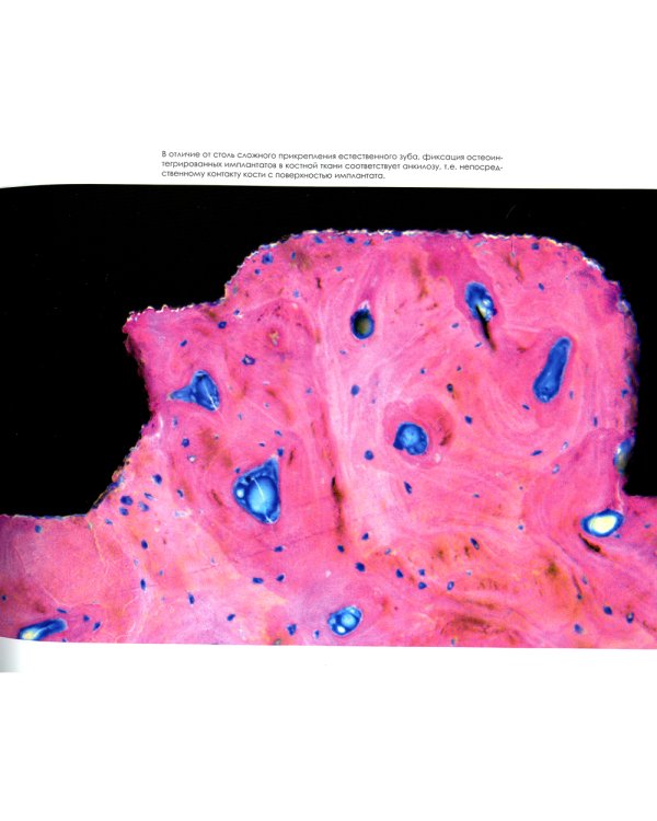 Эволюция. Актуальные протоколы замещения передних зубов с помощью имплантатов