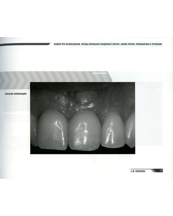 Мукогингивальная хирургия вокруг зубов и имплантатов: работа над ошибками