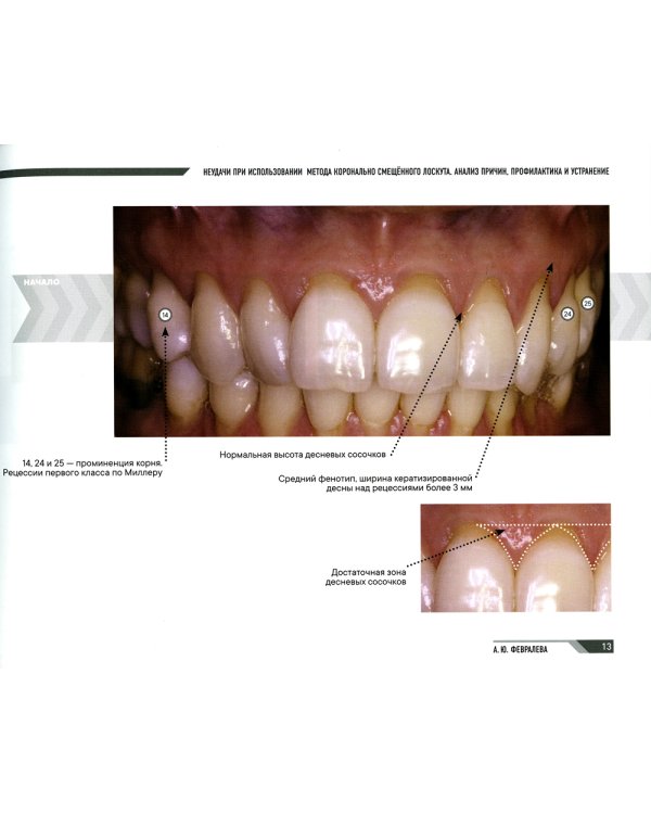 Мукогингивальная хирургия вокруг зубов и имплантатов: работа над ошибками
