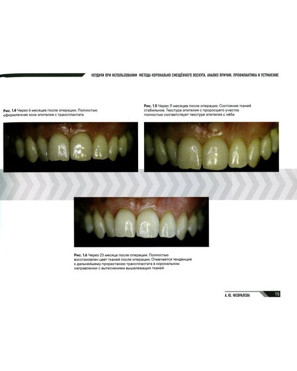 Мукогингивальная хирургия вокруг зубов и имплантатов: работа над ошибками