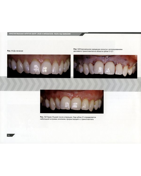 Мукогингивальная хирургия вокруг зубов и имплантатов: работа над ошибками