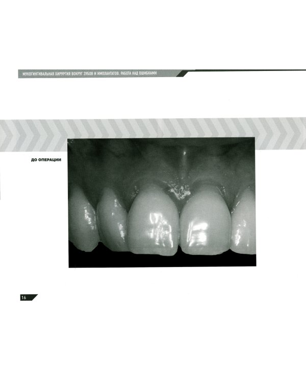 Мукогингивальная хирургия вокруг зубов и имплантатов: работа над ошибками