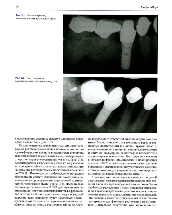 Несостоятельность дентальной имплантации