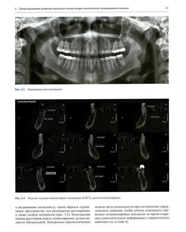 Несостоятельность дентальной имплантации