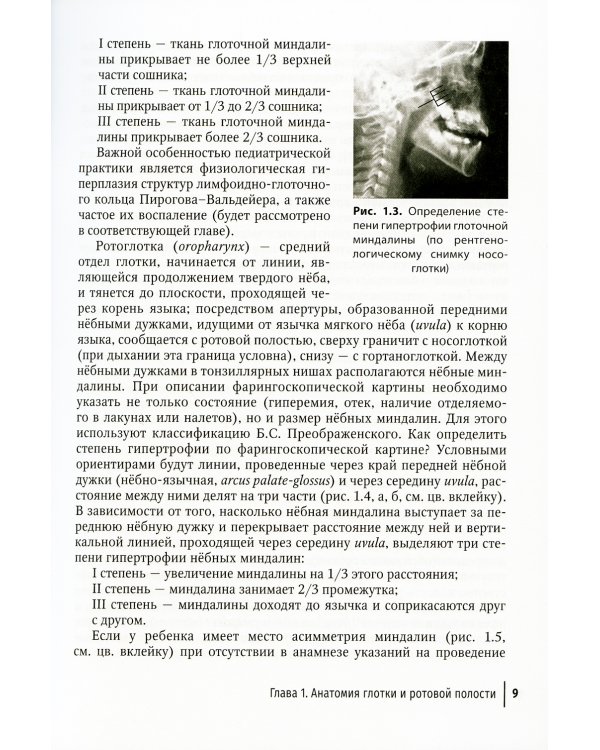 Острый тонзиллофарингит у детей