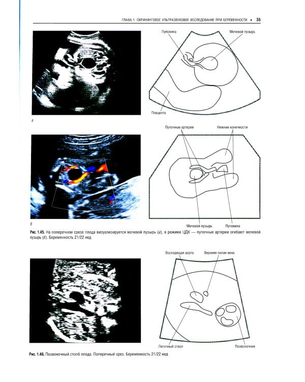 Практическая ультразвуковая диагностика: Руководство для врачей. В 5 т. Т. 4. Ультразвуковая диагностика в акушерстве
