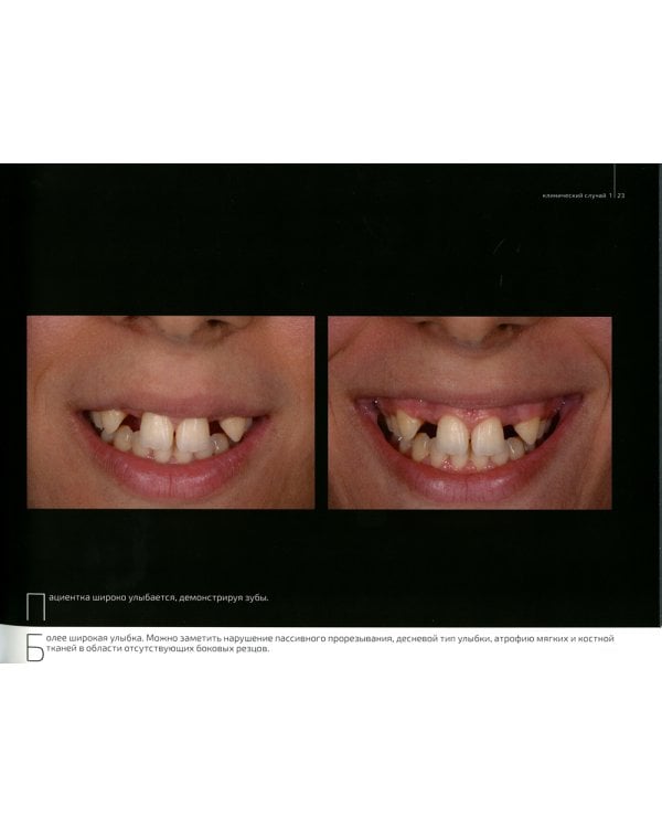 Эстетическая имплантация. Сложные клинические случаи работы во фронтальных отделах с глобальным подходом к реконструкции улыбки пациента