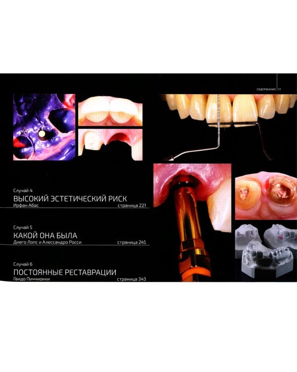 Эстетическая имплантация. Сложные клинические случаи работы во фронтальных отделах с глобальным подходом к реконструкции улыбки пациента