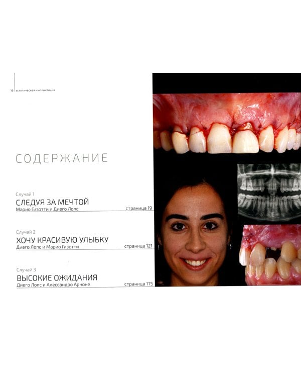 Эстетическая имплантация. Сложные клинические случаи работы во фронтальных отделах с глобальным подходом к реконструкции улыбки пациента