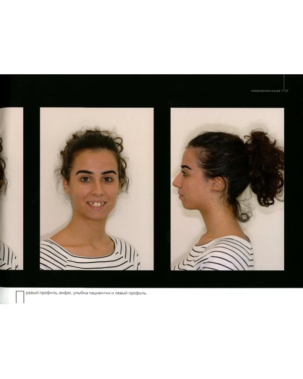 Эстетическая имплантация. Сложные клинические случаи работы во фронтальных отделах с глобальным подходом к реконструкции улыбки пациента