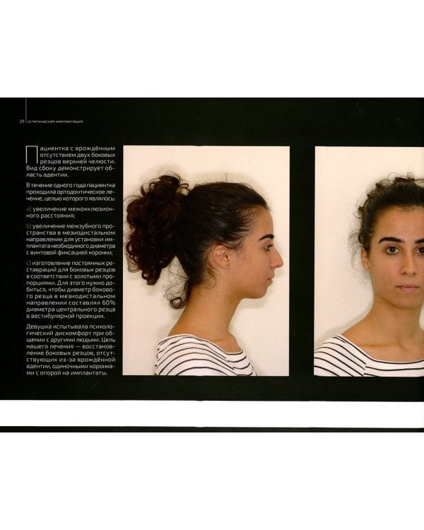 Эстетическая имплантация. Сложные клинические случаи работы во фронтальных отделах с глобальным подходом к реконструкции улыбки пациента