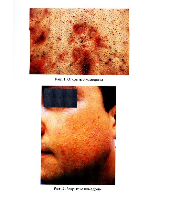 Акне у подростков