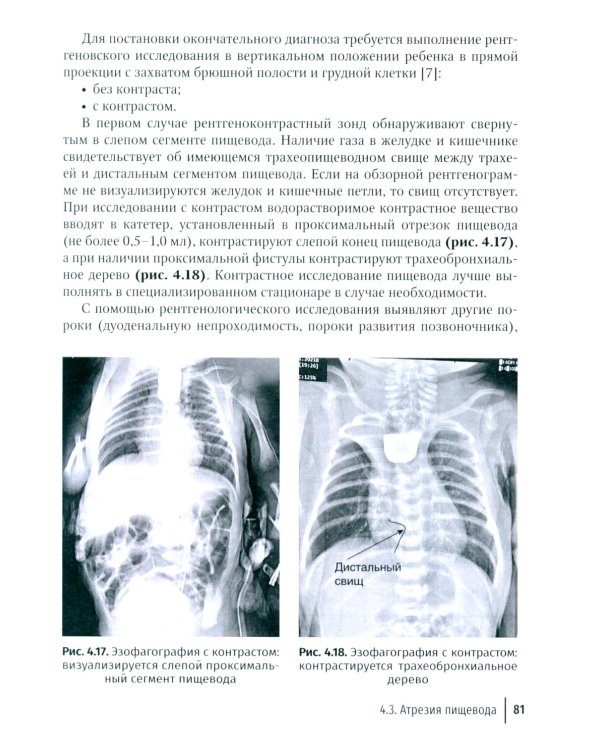 Дисфагия у детей