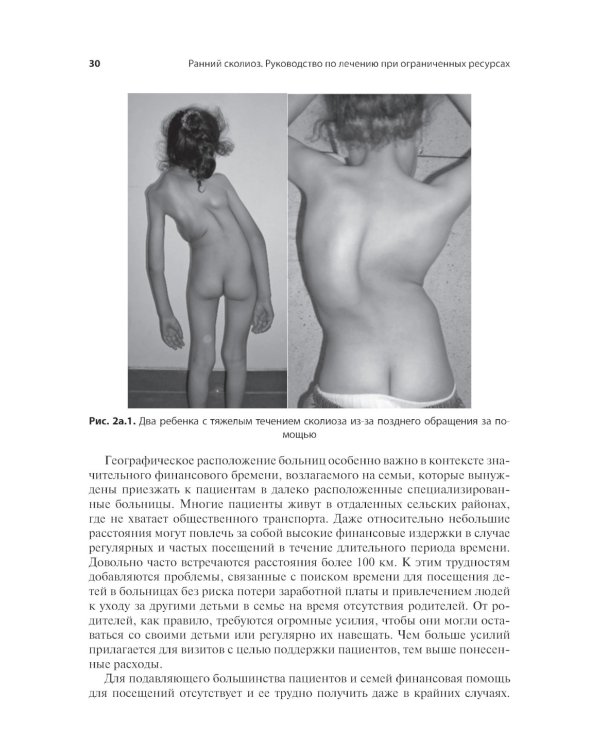 Ранний сколиоз. Руководство по лечению при ограниченных ресурсах