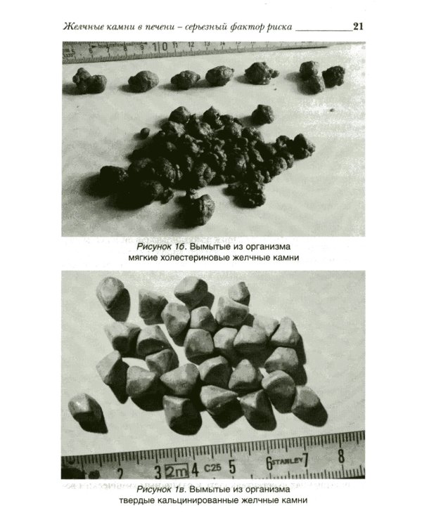 Удивительное очищение печени и желчного пузыря