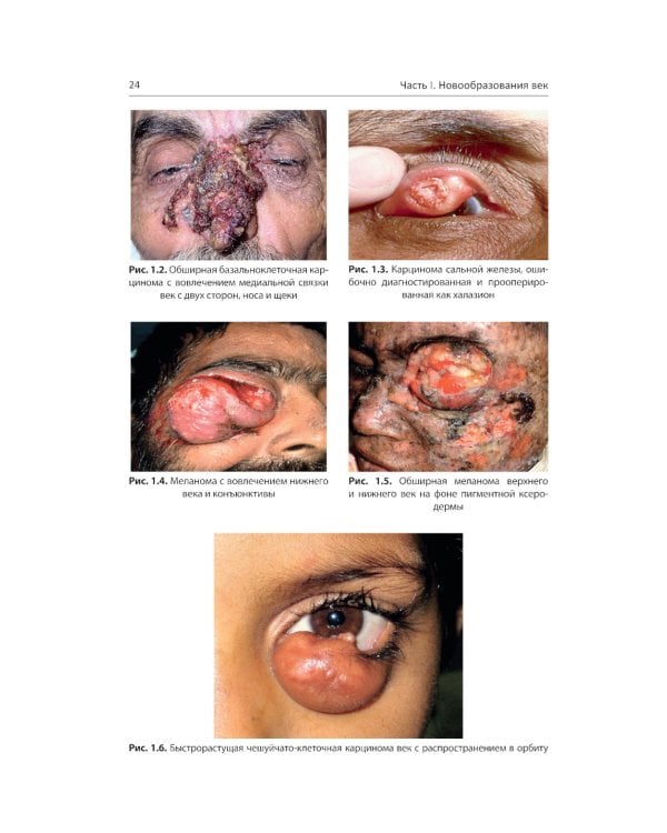 Хирургическая офтальмоонкология