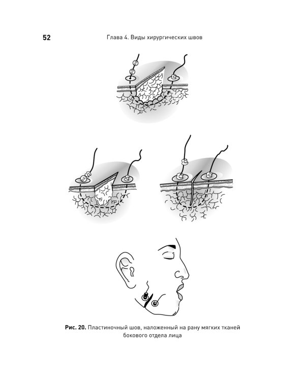 Хирургический шов. 3-е изд., обновлен