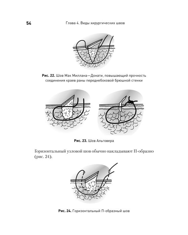 Хирургический шов. 3-е изд., обновлен