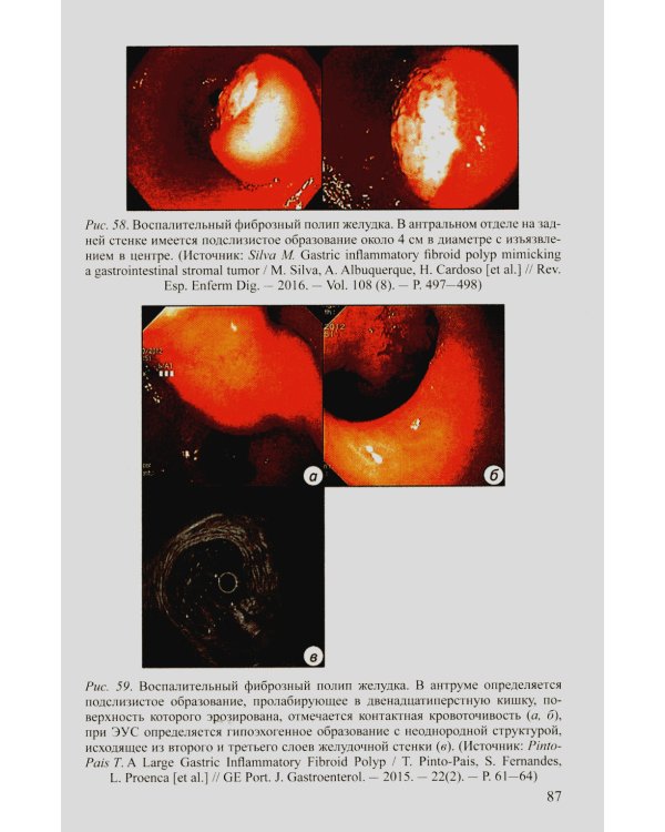 Доброкачественные опухоли желудка. Ч. 1: Эпителиальные опухоли и опухолеподобные поражения: Учебно-методическое пособие. 2-е изд., испр. и доп