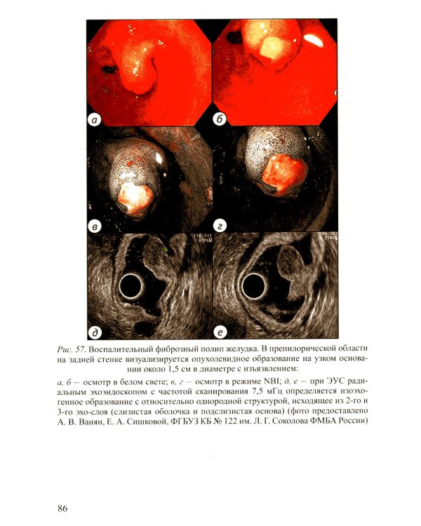 Доброкачественные опухоли желудка. Ч. 1: Эпителиальные опухоли и опухолеподобные поражения: Учебно-методическое пособие. 2-е изд., испр. и доп