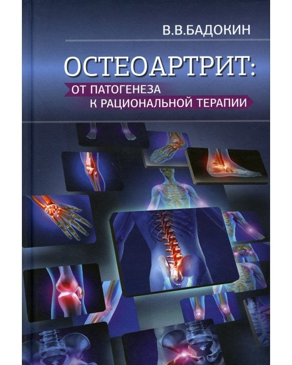 Остеоартрит: от патогенеза к рациональной терапии