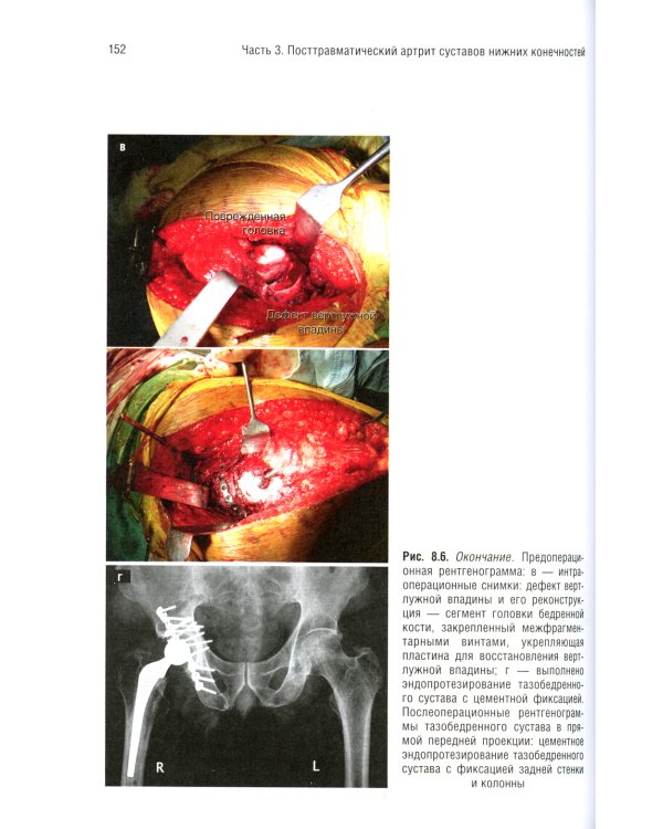 Посттравматический артрит. Диагностика, лечение и результаты
