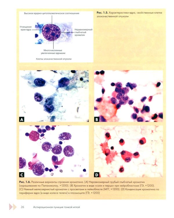 Аспирационная пункция тонкой иглой. Трактовка результатов и диагностические проблемы