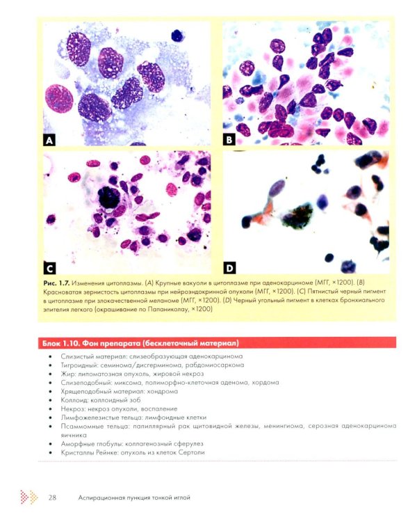 Аспирационная пункция тонкой иглой. Трактовка результатов и диагностические проблемы