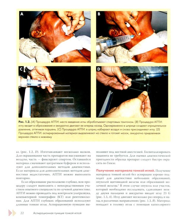 Аспирационная пункция тонкой иглой. Трактовка результатов и диагностические проблемы