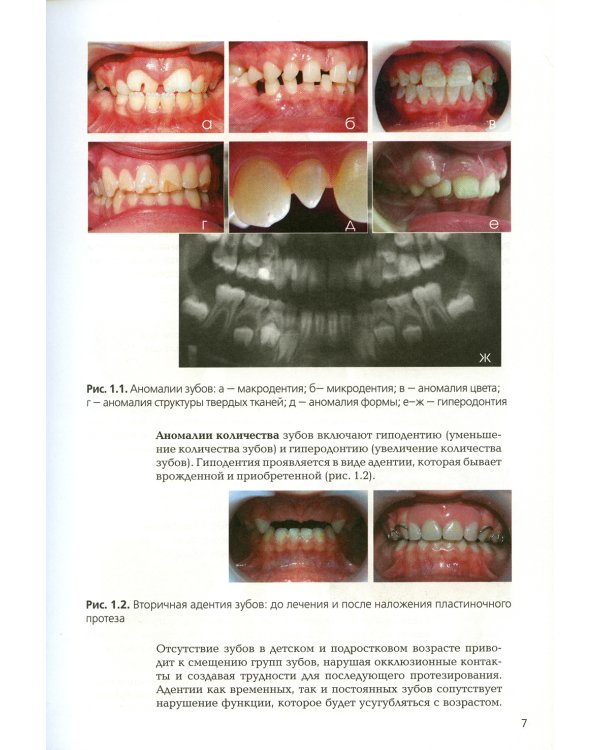 Ортодонтия. Ортодонтические аппараты при лечении зубочелюстных аномалий