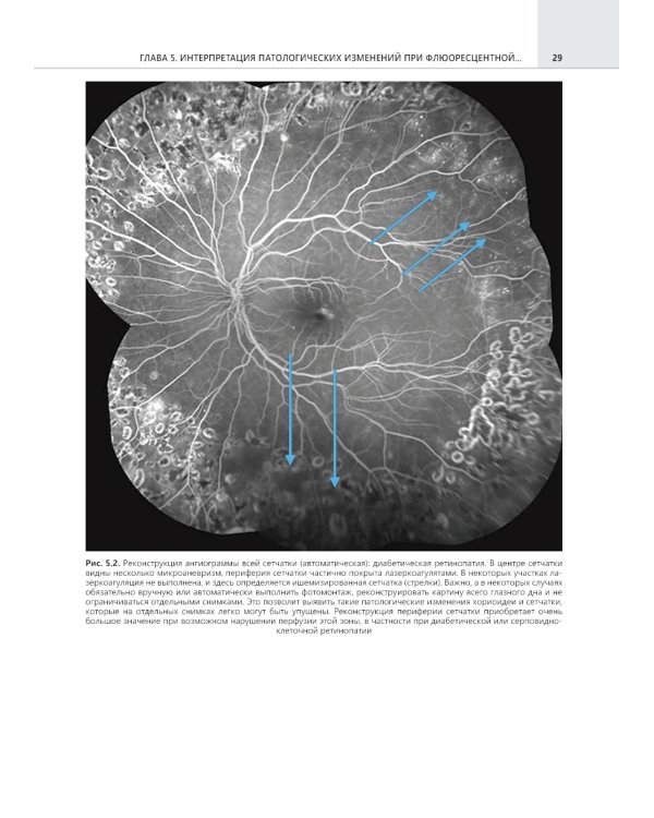 Флюоресцентная ангиография заднего полюса и периферии сетчатки: практическое руководство