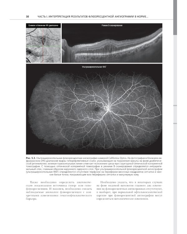 Флюоресцентная ангиография заднего полюса и периферии сетчатки: практическое руководство