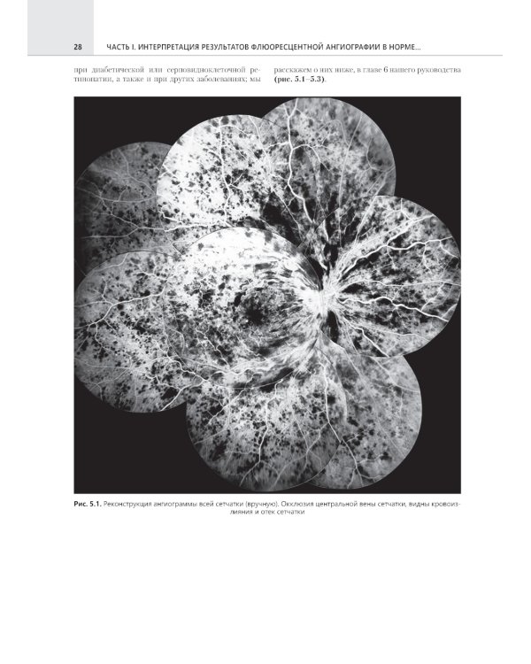 Флюоресцентная ангиография заднего полюса и периферии сетчатки: практическое руководство