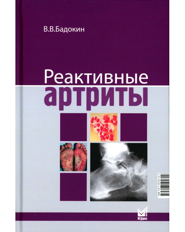Реактивные артриты. Урогенитальные и постэнтероколитические. 2-е изд