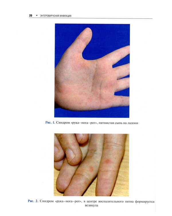 Инфекционные экзантемы у детей в практике врача-дерматовенеролога: руководство для врачей