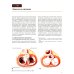 Реконструктивная хирургия клапанов сердца по Карпантье: от анализа клапана к его реконструкции